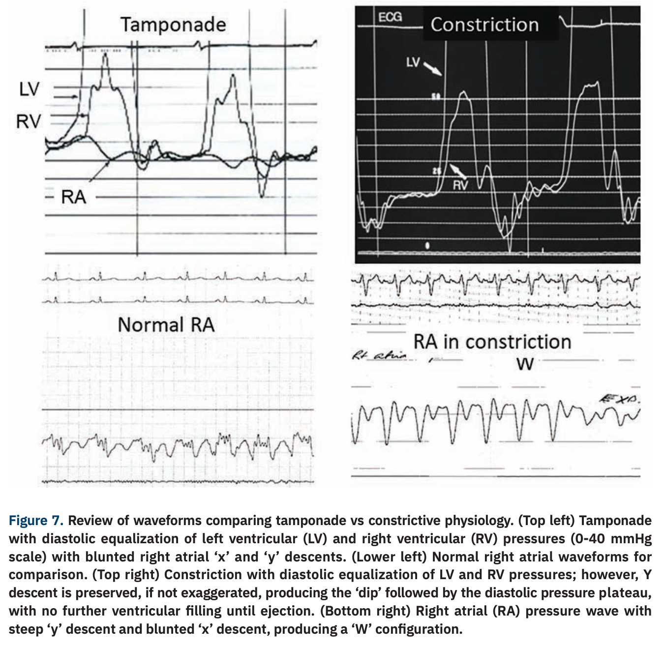 Hemodynamics That Can Make For a Lifesaving Decision in the Cath Lab